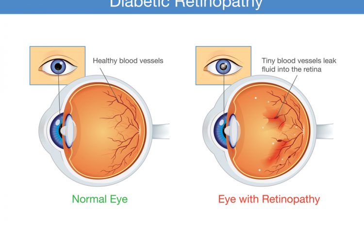  5 Things You Should Know About Diabetic Eye Disease