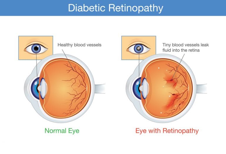 5 Things You Should Know About Diabetic Eye Disease