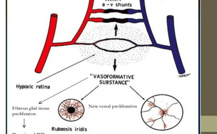  How to Choose the Best Cataract Surgery in South Delhi: A Complete Patient Guide to Safer Motiyabind Treatment