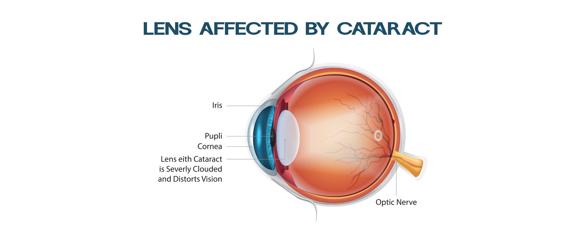 Best Glaucoma Surgery in Lajpat Nagar