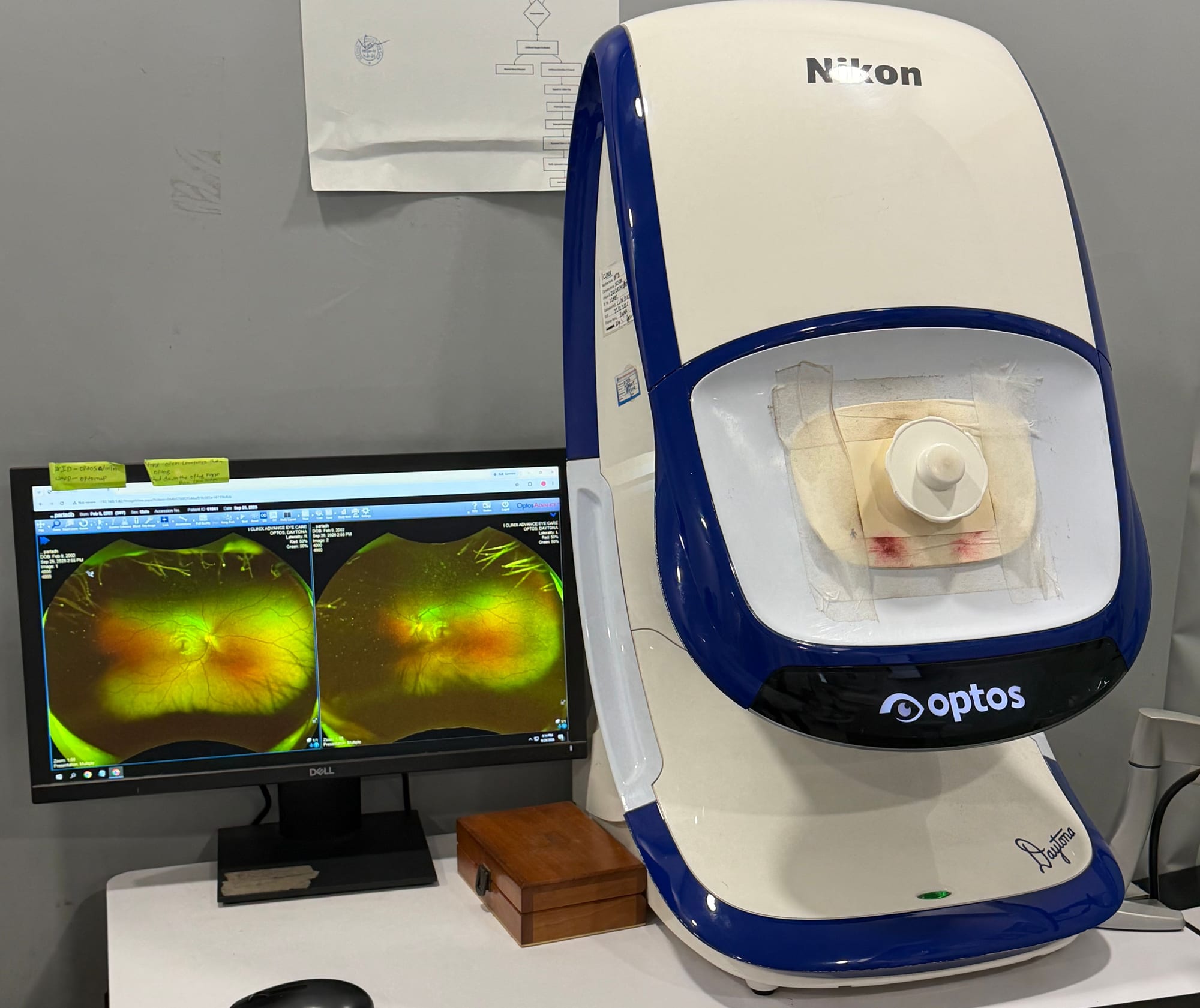 Optos ultra-widefield retinal camera with retina scans on screen